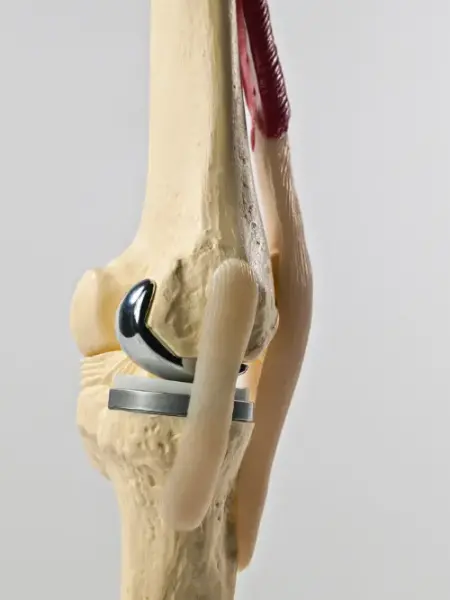 Cirugía de Prótesis de Rodilla en Mazatlán