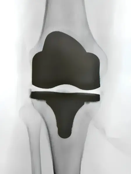 Cirugía de Prótesis de Rodilla en Mazatlán
